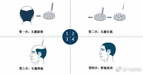 最新植发技术重塑自信，焕发新生活之美貌革命