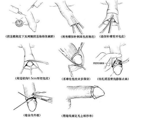 前沿包皮手术技术探索，最新方法与优势解析